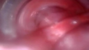 Endoscopy in the Urethra